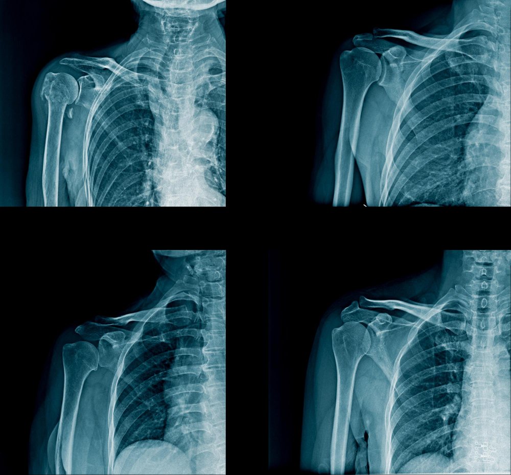 IRM de l’épaule Kenitra